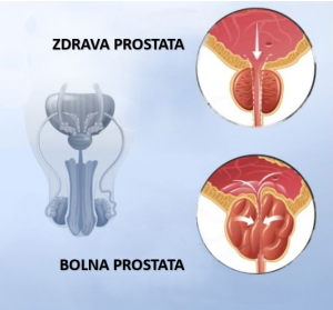 Prostata-3